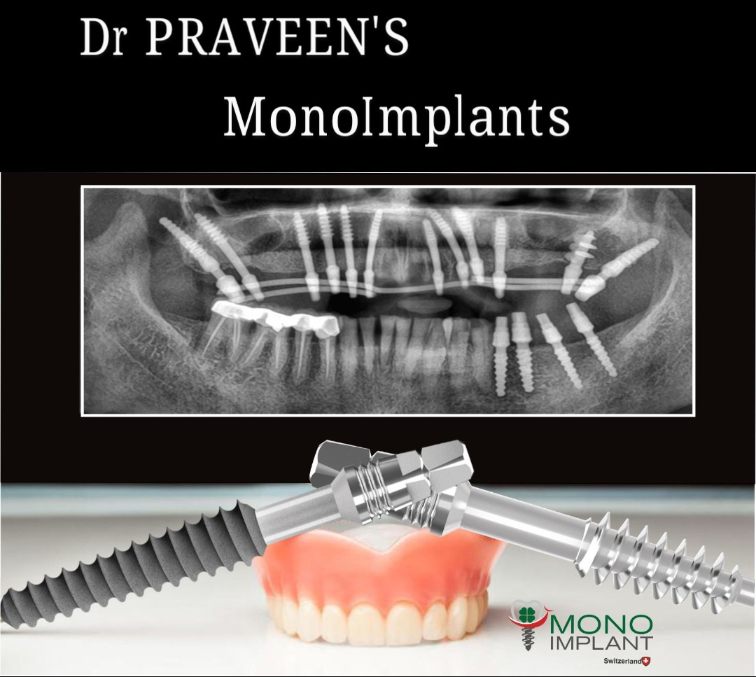 Swiss Mono Implant close-up